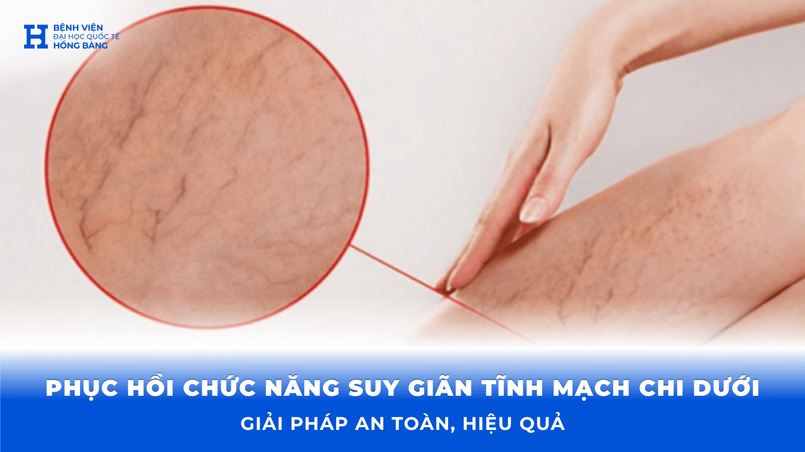 Phục hồi chức năng suy giãn tĩnh mạch chi dưới: Giải pháp an toàn, hiệu quả