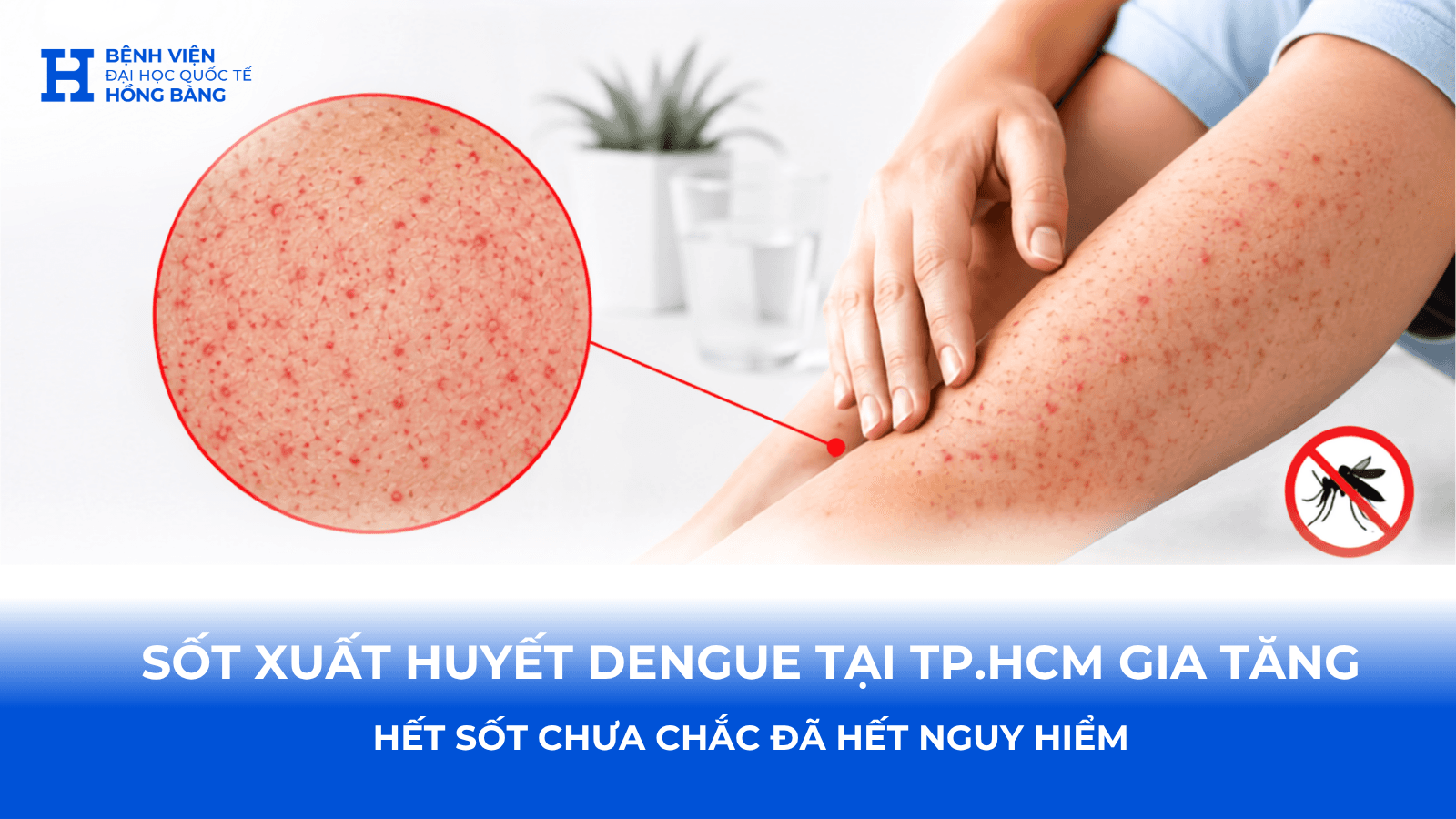Sốt xuất huyết Dengue tại TP.HCM gia tăng: Những điều cần biết để tránh sai lầm